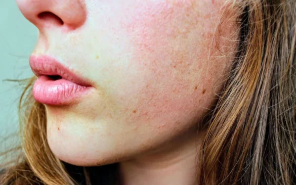 One Unexpected Way To Reduce Inflammation Heal Your Skin